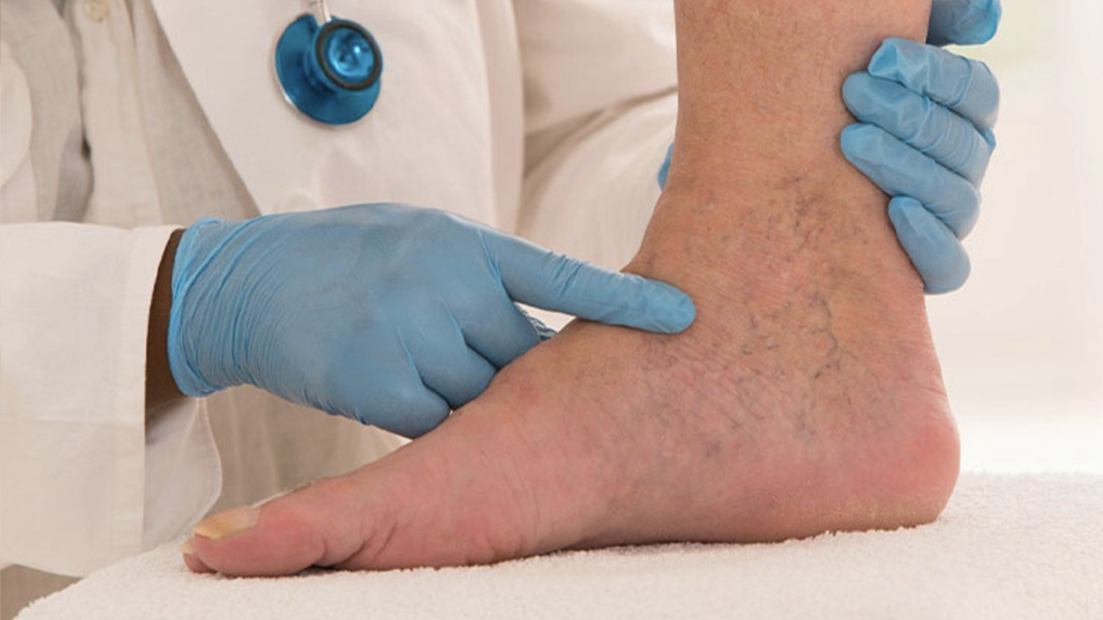 Bacakta şişlik ve ağrı hissedenler dikkat: “Derin Ven Trombozu”nun işaretçisi olabilir!